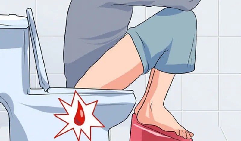 Hình Ảnh Trĩ 32 Ảnh Chọn Lọc Giúp Bạn Tự So Sánh Chính Xác · ảnh 2