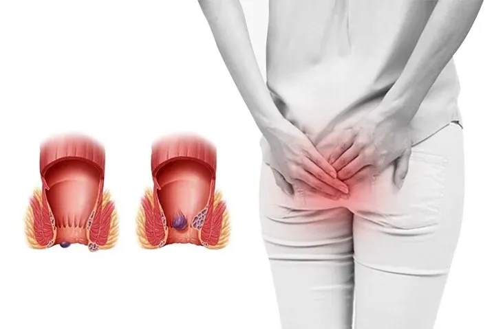 Hình Ảnh Trĩ 32 Ảnh Chọn Lọc Giúp Bạn Tự So Sánh Chính Xác